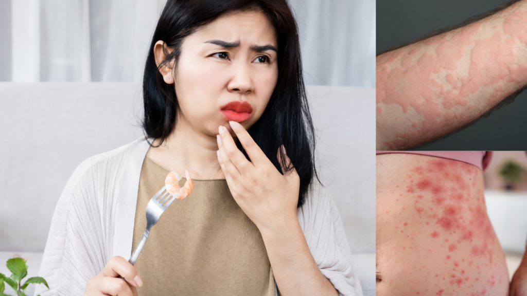 How long does anaphylaxis last